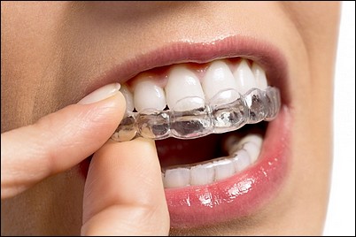 Invisalign Invisalign